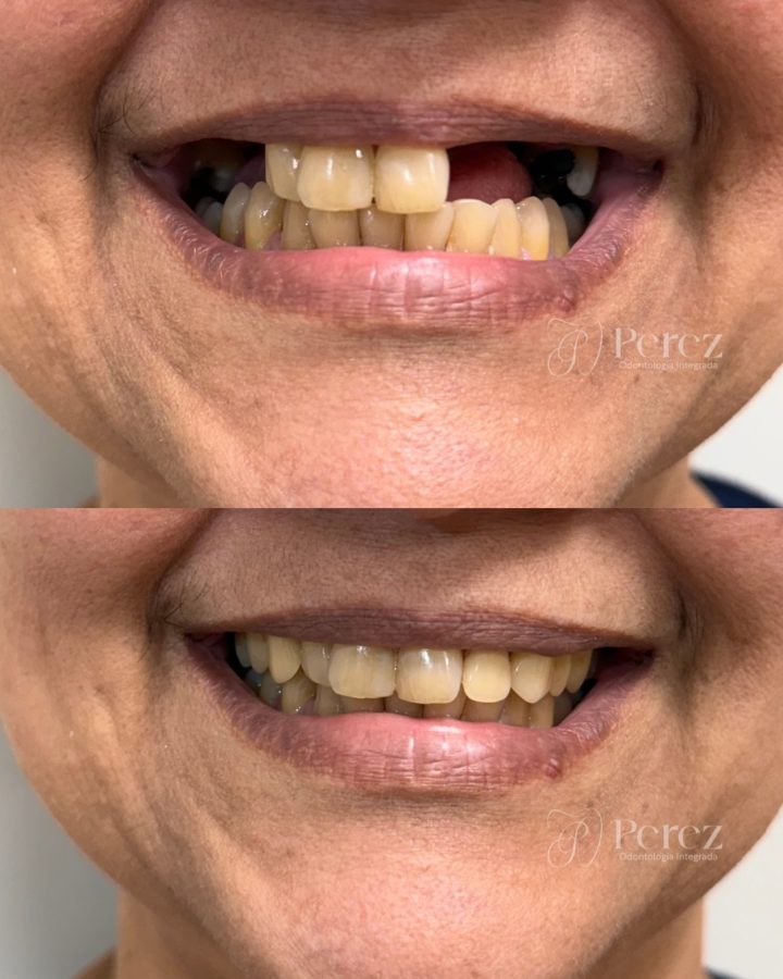 antes e depois novo 3
